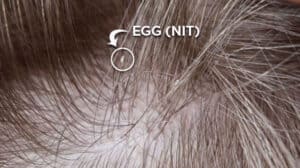 Lice egg or nit on hair shaft up close